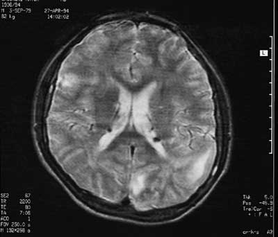 Guzki okołokomorowe i guzki korowe widoczne w obrazie MRI pacjenta z TSC