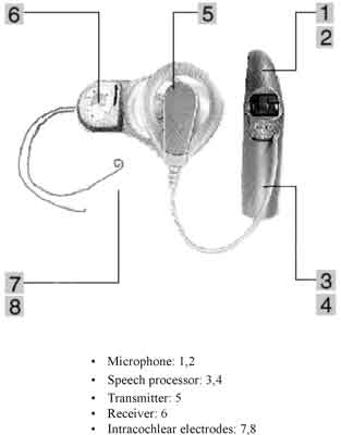 Cochlear implant: a schematic