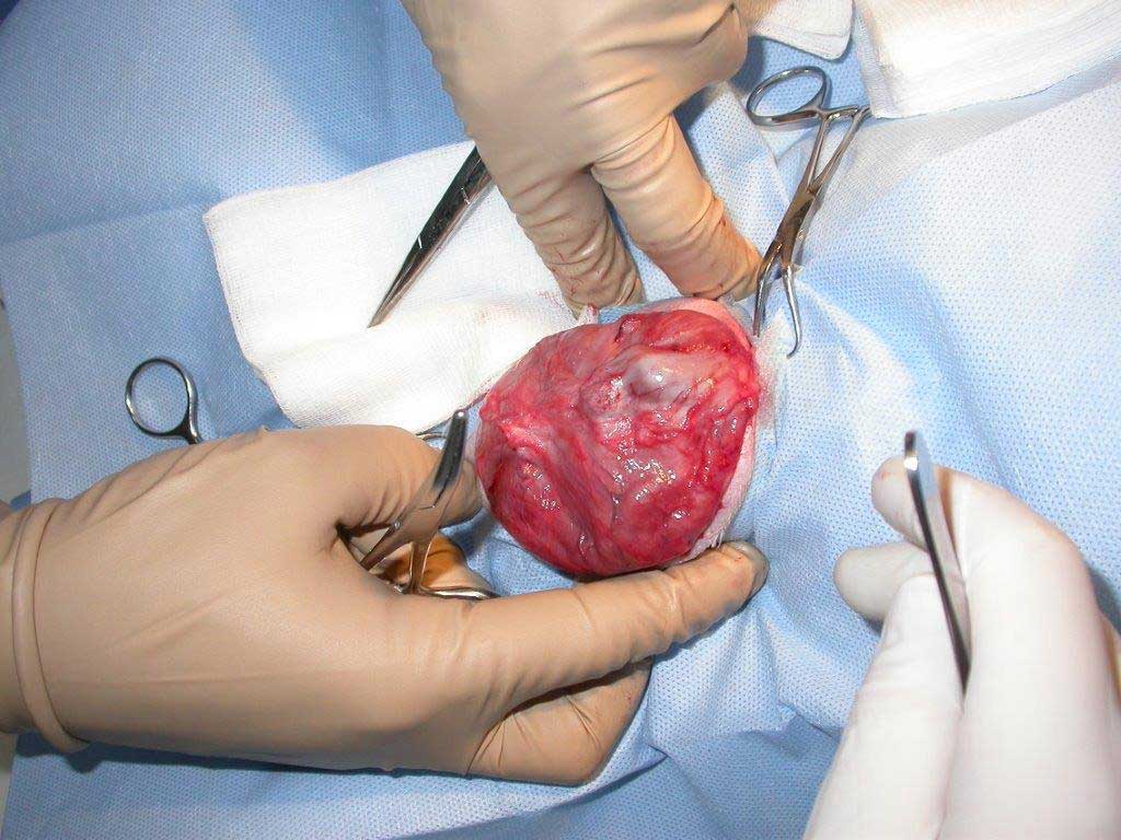 Abdominal Hernia Repair Surgery With The New Injectable Polymer