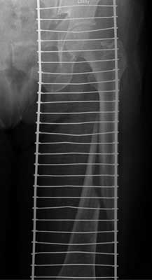 Midshaft spiral fracture of the femur