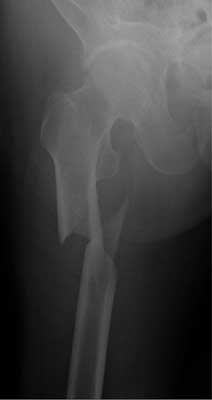 Spiral fracture of the proximal femoral shaft