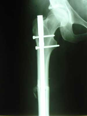 Transverse femoral shaft fracture, 19 days after injury