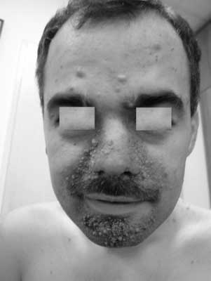 Naczyniakowłókniaki na twarzy u mężczyzny z TSC
