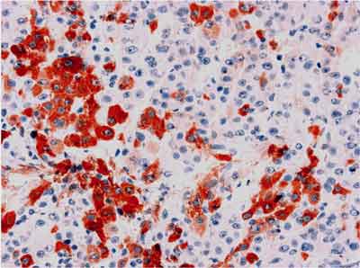 Expression of HCVAgs in hepatocellular carcinoma. EnVision, x125