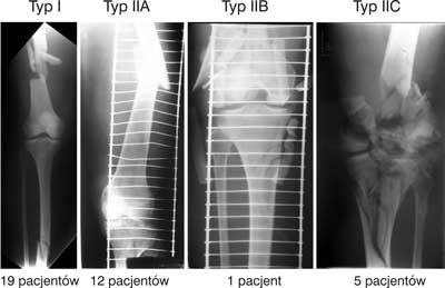 Rodzaje złamań jednostronnych uda i podudzia wg podziału Frasera