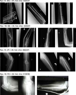 Przykłady złamań kości przedramienia u pacjentów i wyniki ich leczenia z użyciem zespoleń śródszpikowych