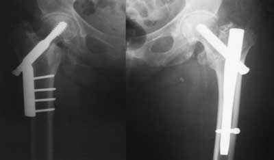 Patinet (W.L) with new trochanteric fracture on L side (several years between surgeries). Fixed with DHS (right) and intramedullary nail (left)