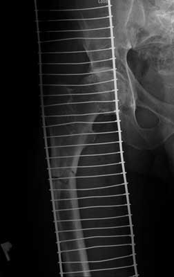 Transverse proximal femoral shaft fracture