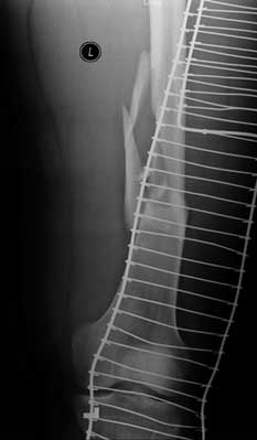 Multifragmentary distal femoral shaft fracture