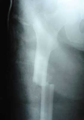 Transverse femoral shaft fracture, 8 days after injury