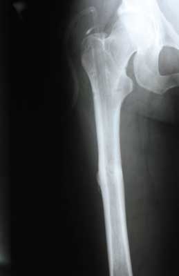 Transverse femoral shaft fracture, 18 months after injury