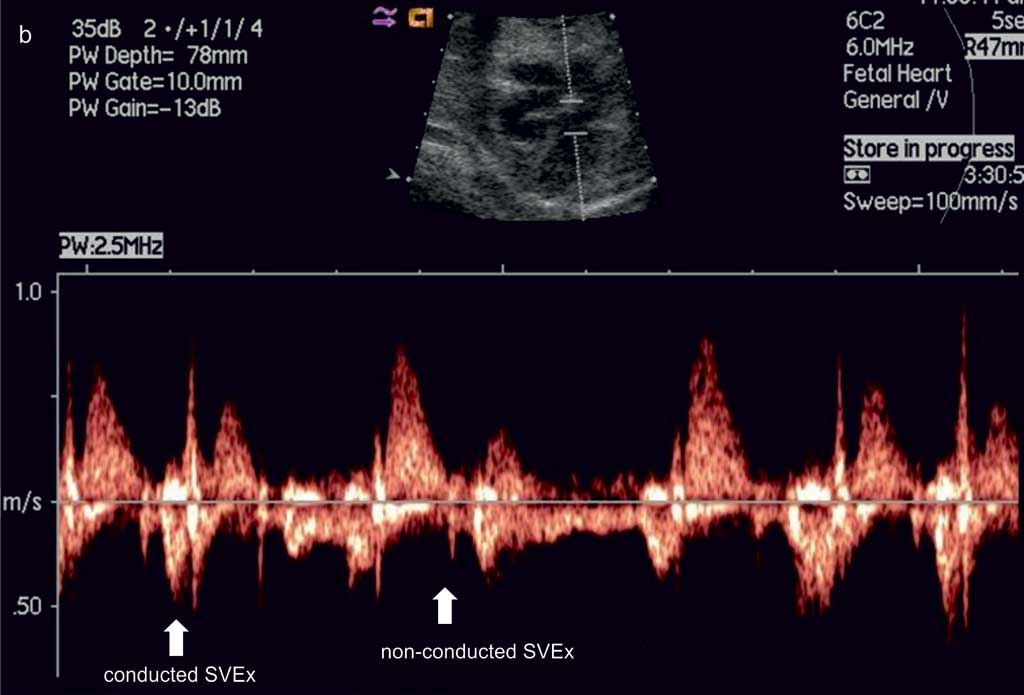 Доплер нормы. Ультразвуковая допплерография маточно-плацентарного кровотока. Показатели Доплера при беременности. Допплерометрическое исследование при беременности. Допплерометрия показатели нормы.